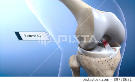 Anterior Cruciate Ligament (ACL) Injury or Tear 89758681