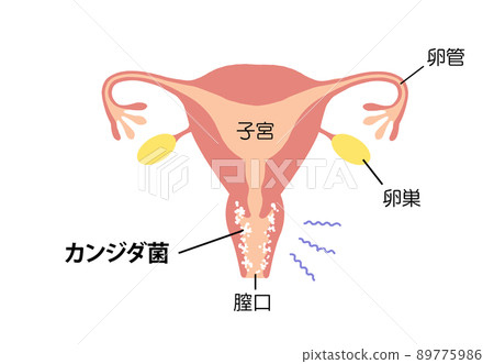 生病子宮的陰道炎插圖 生病子宮的陰道炎插圖 89775986