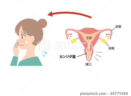 Vaginitis Illustration of a sick uterus 89775989
