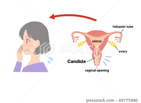Vaginitis Illustration of a sick uterus 89775990
