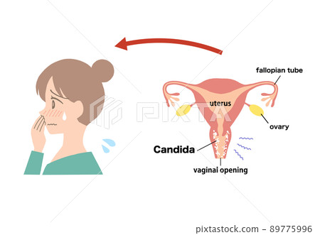 Vaginitis Illustration of a sick uterus 89775996
