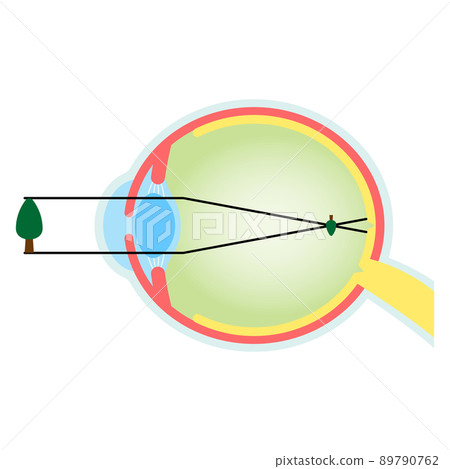 高度近視焦點眼球橫斷面圖 89790762