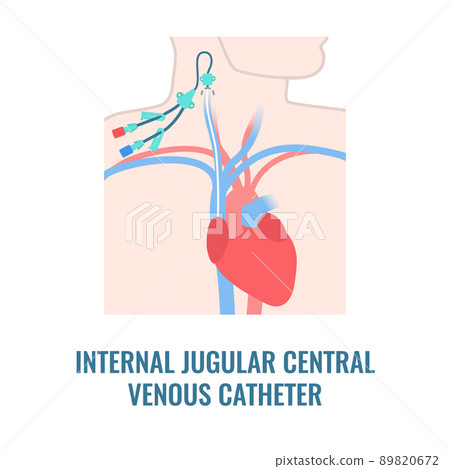 Internal jugular central venous catheter close up 89820672