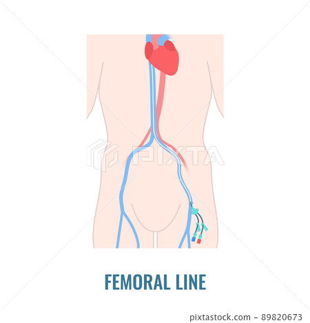 Femoral central line venous catheter close up 89820673