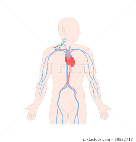 Central venous catheter in the jugular vein 89822717
