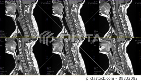 set of 6 sagittal MRI scans of neck area of caucasian 34 years old male with bilateral paramedial extrusion of the C6-C7 segment with radiculopathy set of 6 sagittal MRI scans of neck area of caucasian 34 years old male with bilateral paramedial extrusion of the C6-C7 segment with radiculopathy 89832082