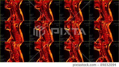 set of 12 sagittal red colored MRI scans of neck area of caucasian 34 years old male with bilateral paramedial extrusion of the C6-C7 segment set of 12 sagittal red colored MRI scans of neck area of caucasian 34 years old male with bilateral paramedial extrusion of the C6-C7 segment 89832094