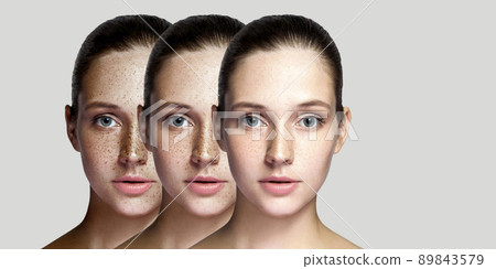 Step by step concept of healing and removing freckles. Closeup portrait of beautiful brunette woman after laser treatment on face looking at camera. indoor studio shot, isolated on gray background. Step by step concept of healing and removing freckles. Closeup portrait of beautiful brunette woman after laser treatment on face looking at camera. indoor studio shot, isolated on gray background. 89843579