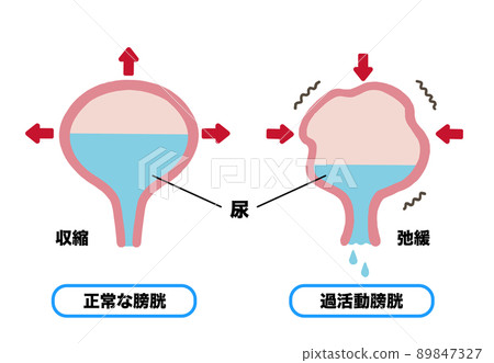 尿失禁膀胱機制說明 89847327