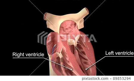 Catheter ablation 3D Medical illustration Catheter ablation 3D Medical illustration 89853294