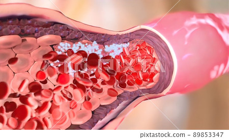 Blood clotting in the circulatory system 89853347