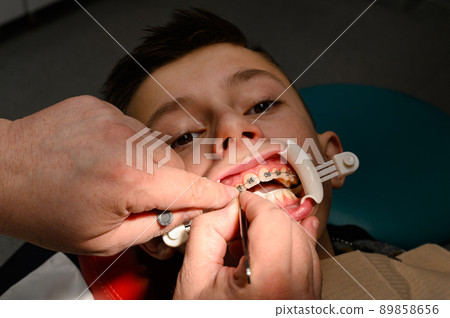 An orthodontist glues and fastens braces on the upper teeth of a schoolboy, aligning teeth with braces. An orthodontist glues and fastens braces on the upper teeth of a schoolboy, aligning teeth with braces. 89858656