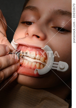 The orthodontist installs braces for the student's boyfriend, visits to the dentist, installation of braces, retractor on the patient's lips. 89858670