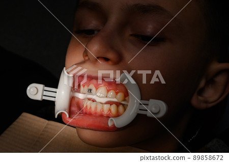 The orthodontist installs braces for the student's boyfriend, visits to the dentist, installation of braces, retractor on the patient's lips. 89858672