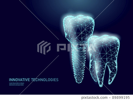 Molar tooth dental implant 3d low poly geometric model. Dentistry innovation future technology titan metal thread. Medical healthy science blue polygonal point line vector illustration 89899195