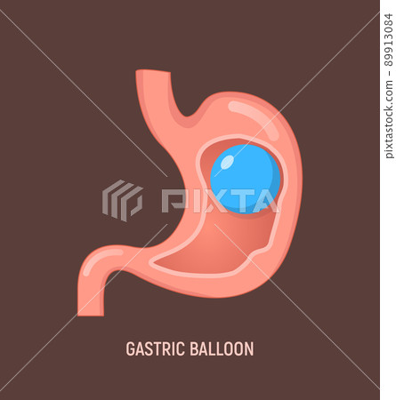 Gastric balloon weight loss intragastric surgery. Stomach gastric balloon operation vector icon 89913084