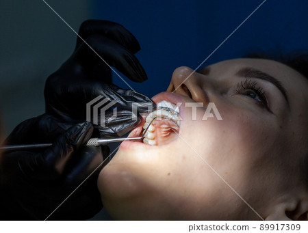 Installing a retainer after wearing braces. The process of removing braces.Beautiful woman in dental chair during procedure of installing braces to upper and lower teeth. Dentist and assistant working Installing a retainer after wearing braces. The process of removing braces.Beautiful woman in dental chair during procedure of installing braces to upper and lower teeth. Dentist and assistant working 89917309