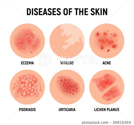Psoriasis rash vector skin hand infection... - Stock Illustration  [89918369] - PIXTA
