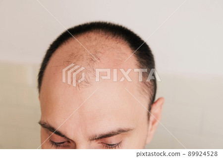 Young caucasian man looking at mirror worried about balding. 89924528