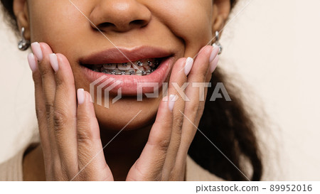 Orthodontic treatment. Teeth with braces Orthodontic treatment. Teeth with braces 89952016