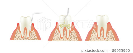 Periodontal disease scaling 89955990