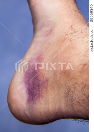 Bruised ankle after tripping over and twisting on right hairy foot on blue background.. Bruised ankle after tripping over and twisting on right hairy foot on blue background.. 89969540