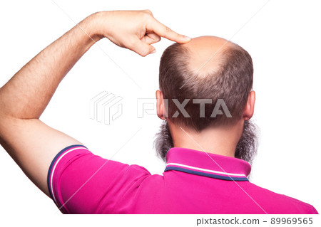 man alopecia baldness hair loss isolated. showing baldness with finger. studio shot. isolated on white.. man alopecia baldness hair loss isolated. showing baldness with finger. studio shot. isolated on white.. 89969565