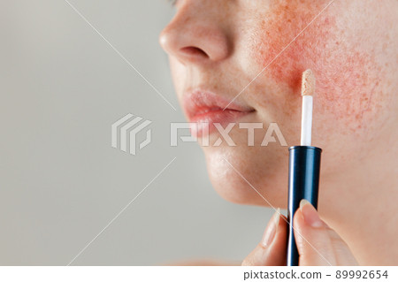 Medicine and cosmetology. Female cheek with rosacea close-up, with cosmetic Foundation on a brush near the skin. Copy space 89992654