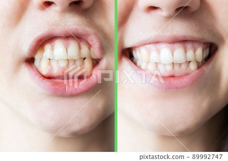 A woman's smile. The result before and after the visit to the orthodontist and dentist. The concept of teeth whitening 89992747