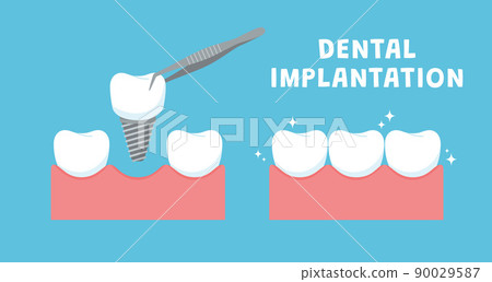 Dental implantation banner or poster layout, flat vector illustration isolated. 90029587