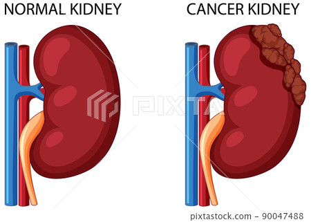 Normal kidney and cancer kidney 90047488