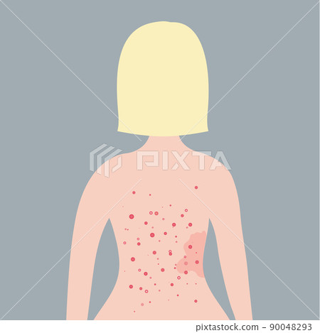 Caucasian short blonde hair woman with acne on her back. Skin problems concept. Caucasian short blonde hair woman with acne on her back. Skin problems concept. 90048293