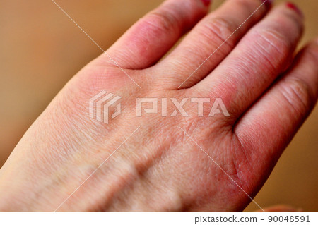 Chilblains swollen fingers Chilblains swollen fingers 90048591