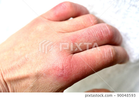 Chilblains swollen fingers Chilblains swollen fingers 90048593