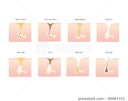 Illustration of types of pore stains Illustration of types of pore stains 90065331