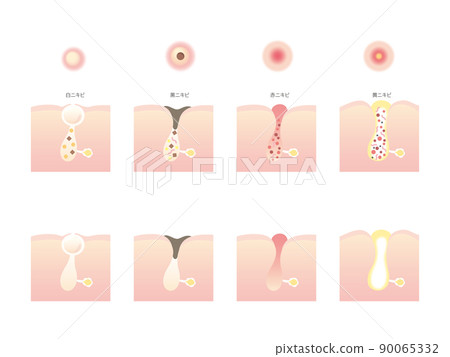 Illustrations of various acne - Stock Illustration [90065332] - PIXTA