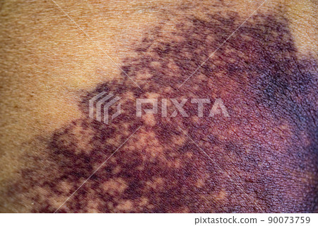 Asian woman dark bruise on the buttocks from a slip accident in the bathroom. Asian woman dark bruise on the buttocks from a slip accident in the bathroom. 90073759