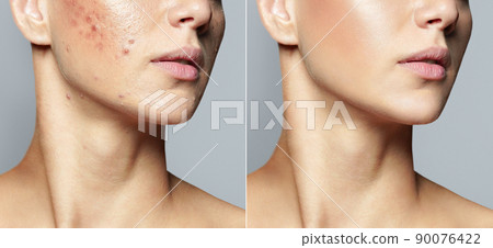 Teenage girl before and after acne treatment Skin care concept. Acne treatment in a cosmetology clinic 90076422
