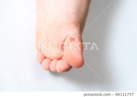 Warts on the soles of children's feet (plantar warts, vulgaris vulgaris, myrmecia) 90112757