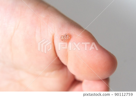 Warts on the soles of children's feet (plantar warts, vulgaris vulgaris, myrmecia) 90112759