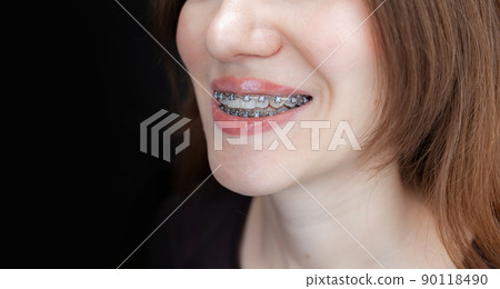 The smile of a young girl with braces on her white teeth. 90118490