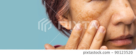 Menopausal women worry about melasma on face. Menopausal women worry about melasma on face. 90123520