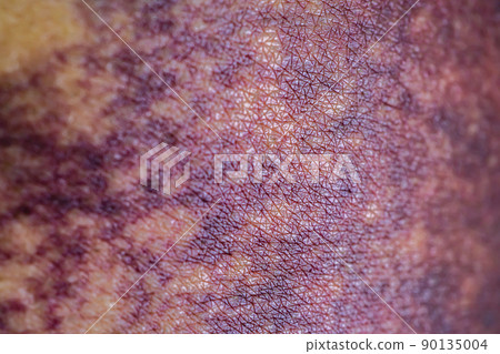 Asian woman dark bruise on the buttocks from a slip accident in the bathroom, close up view. Asian woman dark bruise on the buttocks from a slip accident in the bathroom, close up view. 90135004