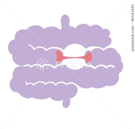 Intestine with stenosis Intestine with stenosis 90141843