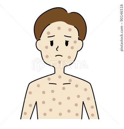 一名感染猴痘並患有全身淋巴結腫大的男孩 一名感染猴痘並患有全身淋巴結腫大的男孩 90146516