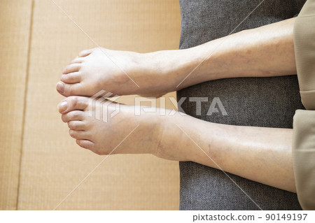 老人腳腫 90149197