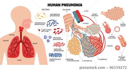 Human Pneumonia Infographic Composition 90159272