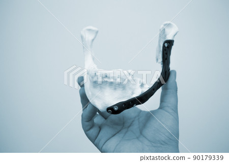 Man holding implantation of endoprosthesis of lower jaw. Model of lower jaw printed on 3D printer white plastic. Endoprosthesis printed on 3D printer for metal biocompatible titanium alloy black color 90179339