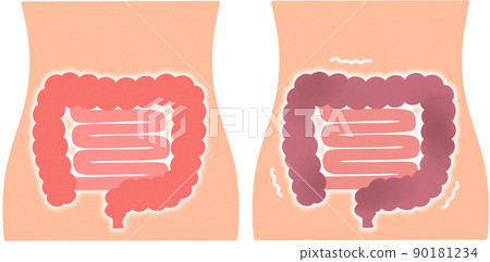 健康的腸子和不健康的腸子 90181234