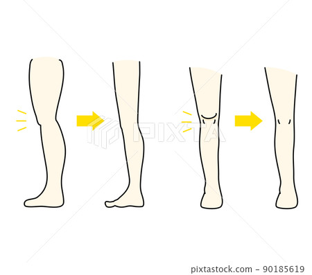 Illustration of before and after eliminating the meat on the hateful knee 90185619